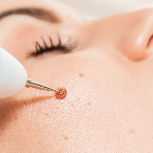 Warts Removal Treatment